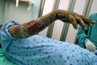 Im Schifa-Krankenhaus werden Phosphorverbrennungen einer Zivilis...