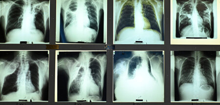 Rasanter Anstieg: In Papua-Neuguinea lag die Zahl der TB-Neuinfe...
