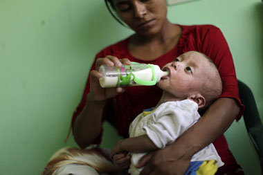 Unterernährtes Kind in Guatemala – ein Beispiel für millionfache... Unterernährtes Kind in Guatemala – ein Beispiel für millionfache...