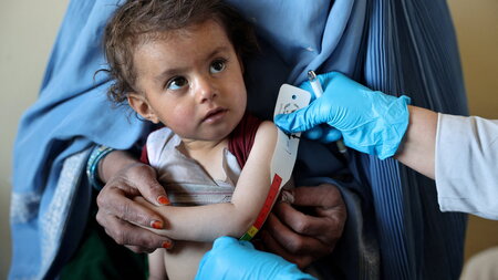 Auch afghanische Kinder leiden an Unterernährung (Kabul, 7.1.202... Auch afghanische Kinder leiden an Unterernährung (Kabul, 7.1.202...